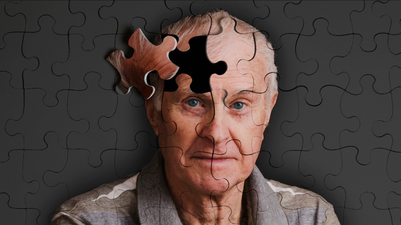 Genetic mutation to cure Alzheimer has been discovered